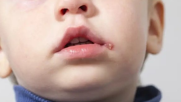 Jangan Cium Anak Sembarangan, Resiko Tertular Penyakit